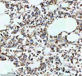 IHC staining of FFPE human breast cancer tissue with SLC16A1 antibody, HRP-secondary and DAB substrate. HIER: boil tissue sections in pH8 EDTA for 20 min and allow to cool before testing.