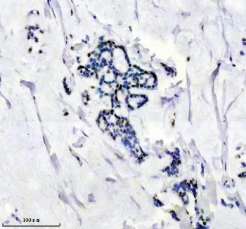 TARDBP Antibody Breast Cancer IHC. Immunohistochemistry analysis of FFPE human breast cancer tissue stained with anti-TARDBP antibody. Following heat-induced epitope retrieval in pH 8 EDTA buffer, distinct HRP-DAB brown nuclear staining is observed in malignant epithelial cells, consistent with the known nuclear localization of TAR DNA-binding protein 43 / TDP-43, an RNA-binding protein involved in RNA splicing, mRNA regulation, and stress-responsive RNA metabolism pathways.