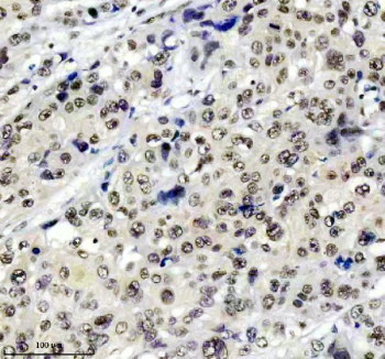 TARDBP Antibody Esophageal Cancer IHC. Immunohistochemistry analysis of FFPE human esophageal cancer tissue stained with anti-TARDBP antibody. Following heat-induced epitope retrieval in pH 8 EDTA buffer, diffuse HRP-DAB brown nuclear staining is observed throughout malignant cell populations, consistent with the known nuclear-associated expression of TAR DNA-binding protein 43 / TDP-43, an RNA-binding protein involved in RNA splicing, stress granule regulation, and post-transcriptional RNA metabolism.
