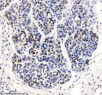 TARDBP Antibody Pancreatic Cancer IHC. Immunohistochemistry analysis of FFPE human pancreatic cancer tissue stained with anti-TARDBP antibody. Following heat-induced epitope retrieval in pH 8 EDTA buffer, strong HRP-DAB brown nuclear staining is observed in tumor cells, consistent with the known nuclear localization of TAR DNA-binding protein 43 / TDP-43, an RNA-binding protein involved in RNA processing, stress granule regulation, and post-transcriptional gene expression pathways.