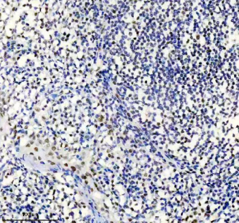 TARDBP Antibody Tonsil IHC. Immunohistochemistry analysis of FFPE human tonsil tissue stained with anti-TARDBP antibody. Following heat-induced epitope retrieval in pH 8 EDTA buffer, nuclear HRP-DAB brown staining is observed in scattered lymphoid and stromal cell populations, consistent with expression of TAR DNA-binding protein 43 / TDP-43, an RNA-binding protein involved in RNA splicing, stress granule dynamics, and post-transcriptional gene regulation.