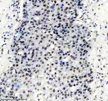 TARDBP Antibody Liver Cancer IHC. Immunohistochemistry analysis of FFPE human liver cancer tissue stained with anti-TARDBP antibody. Following heat-induced epitope retrieval in pH 8 EDTA buffer, strong HRP-DAB brown nuclear staining is observed throughout malignant cell populations, consistent with the known nuclear localization of TAR DNA-binding protein 43 / TDP-43, an RNA-binding protein involved in RNA splicing, mRNA stability, and stress-responsive RNA regulatory pathways.