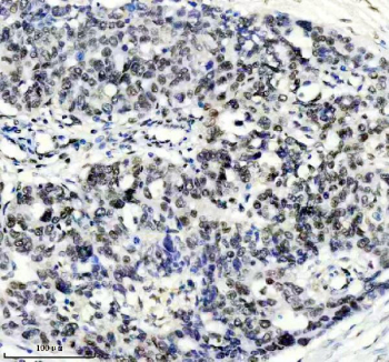 TARDBP Antibody Ovarian Cancer IHC. Immunohistochemistry analysis of FFPE human ovarian cancer tissue stained with anti-TARDBP antibody. Following heat-induced epitope retrieval in pH 8 EDTA buffer, widespread HRP-DAB brown nuclear staining is observed in malignant epithelial cells, consistent with expression of TAR DNA-binding protein 43 / TDP-43, an RNA-binding protein involved in RNA splicing, mRNA transport, and stress-responsive RNA metabolism pathways.
