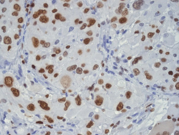 TAR DNA binding protein 43 Antibody Glioma IHC. Immunohistochemistry staining of FFPE human glioma tissue with TAR DNA binding protein 43 antibody, HRP-secondary and DAB substrate. HIER: boil tissue sections in pH8 EDTA for 20 min and allow to cool before testing.