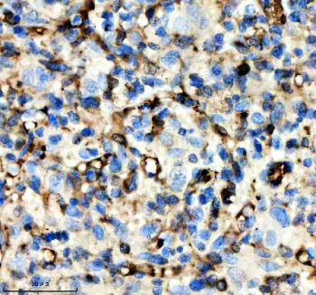 IHC staining of FFPE human glioma tissue with Alpha-Synuclein antibody, HRP-secondary and DAB substrate. HIER: boil tissue sections in pH8 EDTA for 20 min and allow to cool before testing.