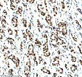 IHC staining of FFPE human breast cancer tissue with Cyclin dependent kinase 9 antibody, HRP-secondary and DAB substrate. HIER: boil tissue sections in pH8 EDTA for 20 min and allow to cool before testing.