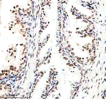 IHC staining of FFPE human prostate cancer tissue with Cyclin dependent kinase 9 antibody, HRP-secondary and DAB substrate. HIER: boil tissue sections in pH8 EDTA for 20 min and allow to cool before testing.