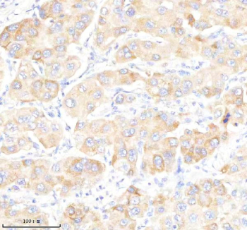 IHC staining of FFPE human liver cancer tissue with GABARAPL2 antibody, HRP-secondary and DAB substrate. HIER: boil tissue sections in pH8 EDTA for 20 min and allow to cool before testing.