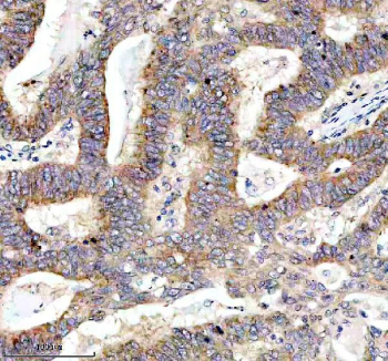 IHC staining of FFPE human stomach cancer tissue with MYO7A antibody, HRP-secondary and DAB substrate. HIER: boil tissue sections in pH8 EDTA for 20 min and allow to cool before testing.