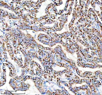 IHC staining of FFPE human thyroid cancer tissue with PDC-E2 antibody, HRP-secondary and DAB substrate. HIER: boil tissue sections in pH8 EDTA for 20 min and allow to cool before testing.