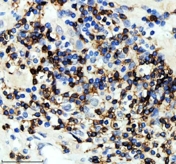 IHC staining of FFPE human prostate cancer tissue with CD247 antibody, HRP-secondary and DAB substrate. HIER: boil tissue sections in pH8 EDTA for 20 min and allow to cool before testing.