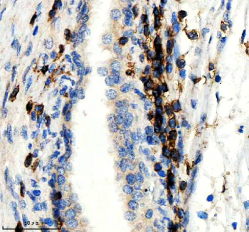 IHC staining of FFPE human prostate cancer tissue with CD247 antibody, HRP-secondary and DAB substrate. HIER: boil tissue sections in pH8 EDTA for 20 min and allow to cool before testing.