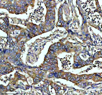 IHC staining of FFPE human colon cancer tissue with CAMK2 antibody, HRP-secondary and DAB substrate. HIER: boil tissue sections in pH8 EDTA for 20 min and allow to cool before testing.