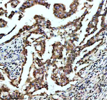 IHC staining of FFPE human lung cancer tissue with FOXF1 antibody, HRP-secondary and DAB substrate. HIER: boil tissue sections in pH8 EDTA for 20 min and allow to cool before testing.