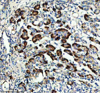 IHC staining of FFPE human pancreas cancer tissue with RAPGEF4 antibody, HRP-secondary and DAB substrate. HIER: boil tissue sections in pH8 EDTA for 20 min and allow to cool before testing.