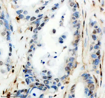 IHC staining of FFPE human pancreas cancer tissue with CIRBP antibody, HRP-secondary and DAB substrate. HIER: boil tissue sections in pH8 EDTA for 20 min and allow to cool before testing.