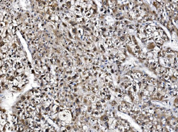 IHC staining of FFPE human liver cancer tissue with GAR1 antibody, HRP-secondary and DAB substrate. HIER: boil tissue sections in pH8 EDTA for 20 min and allow to cool before testing.