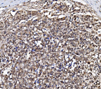 IHC staining of FFPE human gastric carcinoma tissue with GAR1 antibody, HRP-secondary and DAB substrate. HIER: boil tissue sections in pH8 EDTA for 20 min and allow to cool before testing.