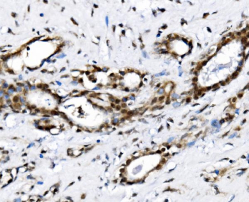 IHC staining of FFPE human breast cancer tissue with GAR1 antibody, HRP-secondary and DAB substrate. HIER: boil tissue sections in pH8 EDTA for 20 min and allow to cool before testing.