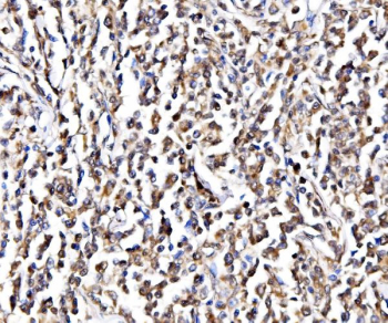 IHC staining of FFPE human lymphoma tissue with GAR1 antibody, HRP-secondary and DAB substrate. HIER: boil tissue sections in pH8 EDTA for 20 min and allow to cool before testing.