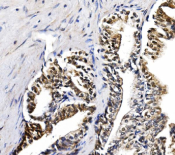 IHC staining of FFPE human prostate cancer tissue with GAR1 antibody, HRP-secondary and DAB substrate. HIER: boil tissue sections in pH8 EDTA for 20 min and allow to cool before testing.