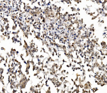 IHC staining of FFPE human pancreatic cancer tissue with GAR1 antibody, HRP-secondary and DAB substrate. HIER: boil tissue sections in pH8 EDTA for 20 min and allow to cool before testing.