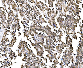 IHC staining of FFPE human ovarian adenoma tissue with GAR1 antibody, HRP-secondary and DAB substrate. HIER: boil tissue sections in pH8 EDTA for 20 min and allow to cool before testing.