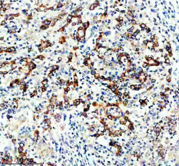 DGAT1 Antibody Human Stomach Cancer IHC. IHC staining of FFPE human stomach cancer tissue with DGAT1 antibody revealed strong cytoplasmic and membranous staining in malignant epithelial cells, consistent with the role of DGAT1 (Diacylglycerol O-Acyltransferase 1) in triglyceride synthesis and lipid droplet formation. DGAT1 is a key regulator of neutral lipid metabolism and has been implicated in metabolic adaptation and tumor cell survival. The widespread staining pattern observed in tumor cells is consistent with increased lipid biosynthesis and energy storage requirements associated with cancer progression. Staining was performed using an HRP-conjugated secondary antibody and DAB chromogen. Heat-induced epitope retrieval was achieved by boiling tissue sections in pH 8 EDTA buffer for 20 minutes followed by cooling before immunostaining.