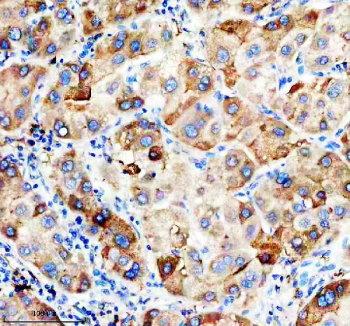 IHC staining of FFPE human liver cancer tissue with Apolipoprotein H antibody, HRP-secondary and DAB substrate. HIER: boil tissue sections in pH8 EDTA for 20 min and allow to cool before testing.