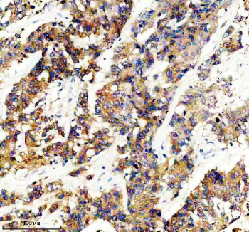 IHC staining of FFPE human colon cancer tissue with GLB1 antibody, HRP-secondary and DAB substrate. HIER: boil tissue sections in pH8 EDTA for 20 min and allow to cool before testing.