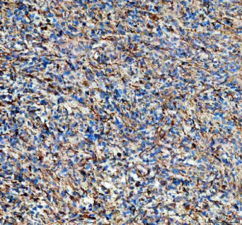 IHC staining of FFPE human glioma tissue with NES antibody, HRP-secondary and DAB substrate. HIER: boil tissue sections in pH8 EDTA for 20 min and allow to cool before testing.