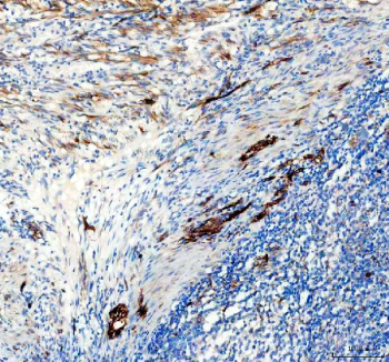 IHC staining of FFPE human diffuse large B-cell lymphoma of the intestine tissue with NES antibody, HRP-secondary and DAB substrate. HIER: boil tissue sections in pH8 EDTA for 20 min and allow to cool before testing.