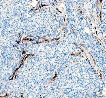 IHC staining of FFPE human non-small cell lung cancer tissue with NES antibody, HRP-secondary and DAB substrate. HIER: boil tissue sections in pH8 EDTA for 20 min and allow to cool before testing.