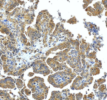 IHC staining of FFPE human ovarian cancer tissue with SNX6 antibody, HRP-secondary and DAB substrate. HIER: boil tissue sections in pH8 EDTA for 20 min and allow to cool before testing.