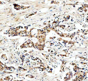 IHC staining of FFPE human breast cancer tissue with USP5 antibody, HRP-secondary and DAB substrate. HIER: boil tissue sections in pH8 EDTA for 20 min and allow to cool before testing.