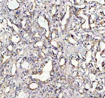 IHC staining of FFPE human prostatic acinar adenocarcinoma tissue with SOCS5 antibody, HRP-secondary and DAB substrate. HIER: boil tissue sections in pH8 EDTA for 20 min and allow to cool before testing.