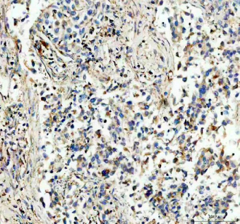 IHC staining of FFPE human lung cancer tissue with NDUFS1 antibody, HRP-secondary and DAB substrate. HIER: boil tissue sections in pH8 EDTA for 20 min and allow to cool before testing.