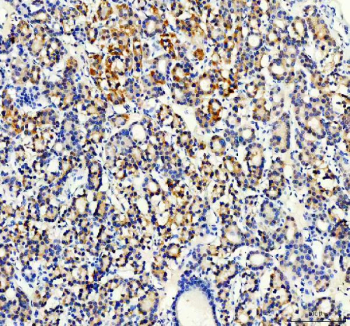 IHC staining of FFPE human thyroid cancer tissue with STXBP4 antibody, HRP-secondary and DAB substrate. HIER: boil tissue sections in pH8 EDTA for 20 min and allow to cool before testing.