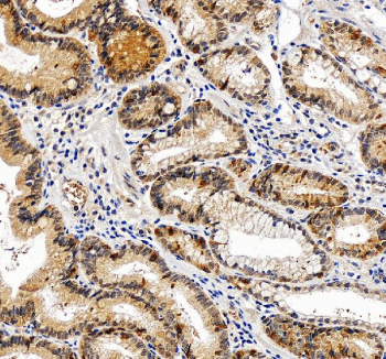 IHC staining of FFPE human stomach cancer tissue with POLR3D antibody, HRP-secondary and DAB substrate. HIER: boil tissue sections in pH8 EDTA for 20 min and allow to cool before testing.