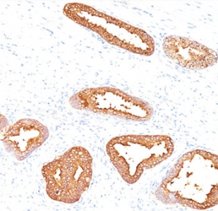 PSA Antibody Clone A67-B/E3 IHC staining of human prostate carcinoma. Immunohistochemistry analysis of FFPE human prostate carcinoma tissue using PSA Antibody Clone A67-B/E3 shows strong HRP-DAB brown cytoplasmic staining in malignant prostate epithelial cells forming glandular tumor structures, consistent with Prostate specific antigen (KLK3) expression in prostate-derived carcinoma cells, while surrounding stromal cells remain largely negative.