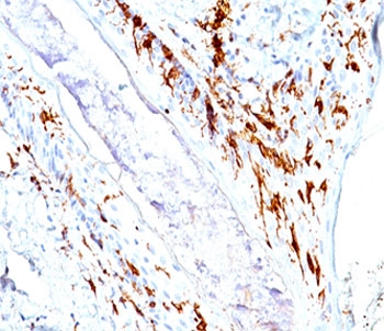 CD1A Antibody for IHC. Immunohistochemistry analysis of CD1A / CD1a expression in human skin tissue using CD1A Antibody. Membranous and cytoplasmic staining is observed in dendritic cells within the epidermis and superficial dermis, consistent with Langerhans cell localization, while surrounding keratinocytes remain largely negative. Increased density and clustering of CD1a-positive cells at the epithelial interface supports involvement of antigen-presenting dendritic cells in local inflammatory responses and immune activation within skin.