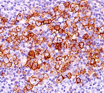 CD30 antibody CD30/412 immunohistochemistry 20X-2