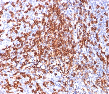 HCAM Antibody Tonsil IHC. Immunohistochemistry analysis of HCAM / CD44 expression in FFPE human tonsil tissue using mouse monoclonal antibody clone 156-3C11. Membranous HRP-DAB brown staining is observed in lymphoid cells within the tonsillar tissue, highlighting widespread cell surface expression consistent with HCAM/CD44 localization on immune cell populations. The staining pattern demonstrates dense distribution of positive cells within lymphoid regions and supports its use for evaluating HCAM/CD44 expression and cellular organization in lymphoid tissue. Heat induced epitope retrieval was performed by boiling tissue sections in pH 9 10mM Tris with 1mM EDTA for 20 min followed by cooling at RT before testing.