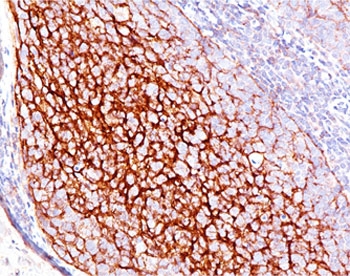 CD35 Antibody Clone E11 Human Tonsil Tissue IHC. Immunohistochemistry testing of human tonsil stained with CD35 antibody (E11). Note cell membrane staining.