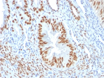 ER Antibody Clone ER506 Endometrium IHC. Immunohistochemistry of ER Antibody in human endometrium. Formalin-fixed, paraffin-embedded human endometrial tissue shows strong nuclear HRP-DAB brown staining in glandular epithelial cells and stromal cells, consistent with Estrogen Receptor expression, while surrounding non-epithelial elements show reduced staining intensity. Staining was performed using clone ER506 following heat-induced epitope retrieval according to standard protocols. The nuclear staining pattern aligns with expected Estrogen Receptor alpha / ESR1 localization in hormonally responsive endometrial tissue.