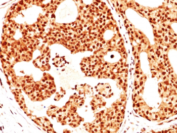 Estrogen Receptor beta Antibody Breast Cancer Tissue IHC. Immunohistochemistry of FFPE human breast carcinoma tissue using Estrogen Receptor beta antibody shows HRP-DAB brown nuclear staining in tumor epithelial cells, consistent with ESR2 expression in hormone-responsive breast cancer, while surrounding stromal elements display lower background; detection was performed with clone ERb455.