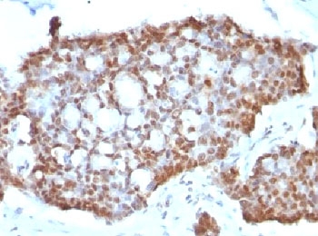 Estrogen Receptor beta Antibody Gastric Carcinoma IHC. Immunohistochemistry of FFPE human gastric carcinoma tissue using Estrogen Receptor beta antibody shows HRP-DAB brown nuclear staining in tumor epithelial cells, consistent with ESR2 expression in hormone-responsive gastric cancer, while adjacent stromal elements display lower background; detection was performed with clone ERb455.