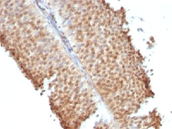 Estrogen Receptor beta Antibody Bladder Carcinoma IHC. Immunohistochemistry of FFPE human bladder carcinoma tissue using Estrogen Receptor beta antibody shows HRP-DAB brown nuclear staining in tumor epithelial cells, consistent with ESR2 expression in bladder cancer, while surrounding stromal regions display lower background; detection was performed with clone ERb455.