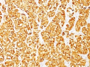 MART-1 Antibody Clone M2-7C10 Human Melanoma Tissue Immunohistochemistry. IHC testing of FFPE human melanoma stained with MART-1 antibody (clone M2-7C10). Note cytoplasmic staining of cells. HIER: boil tissue sections in pH 9 10mM Tris with 1mM EDTA for 10-20 min.