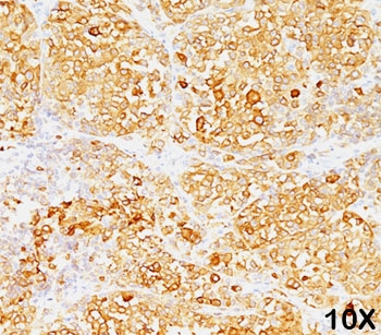 Melan-A Antibody Clone M2-9E3 Human Melanoma IHC. Formalin/paraffin human melanoma stained with MART-1 / Melan-A antibody (clone M2-9E3). Note cytoplasmic staining of cells.